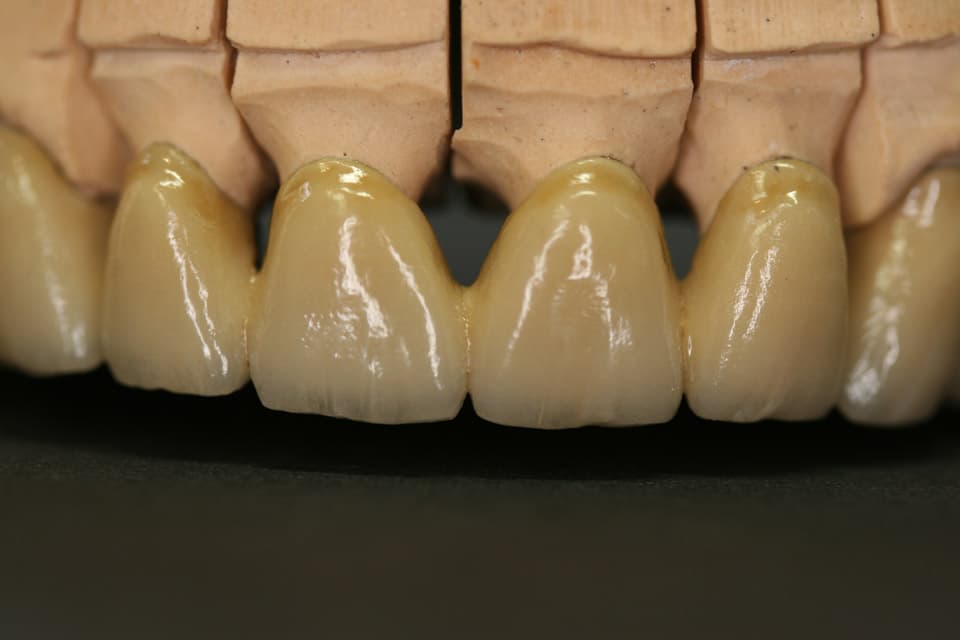 Restauration esthétique finalisée