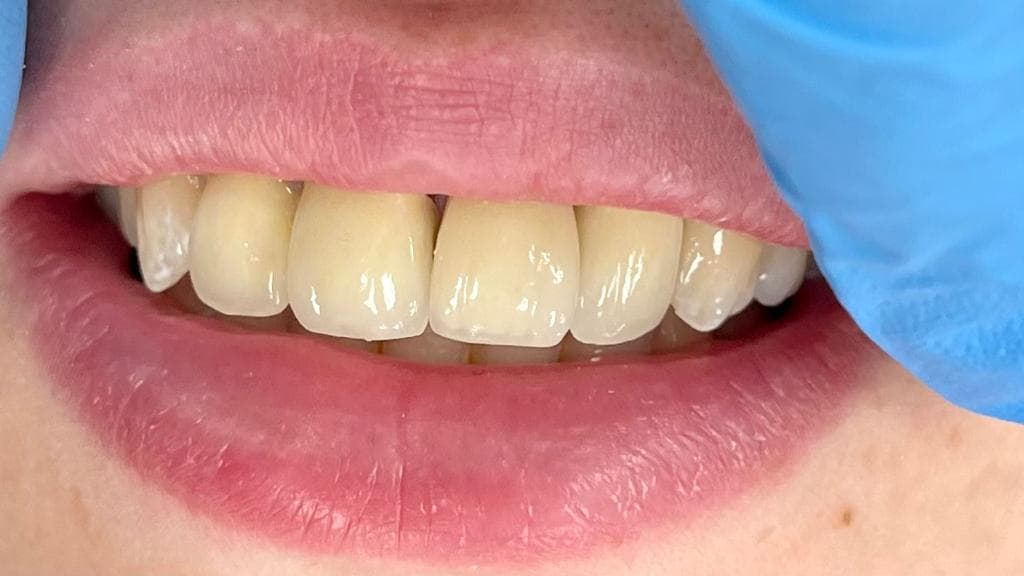 Prothèse dentaire - vue 1