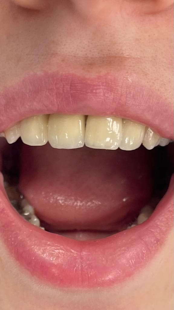 Prothèse à fort rendu esthétique