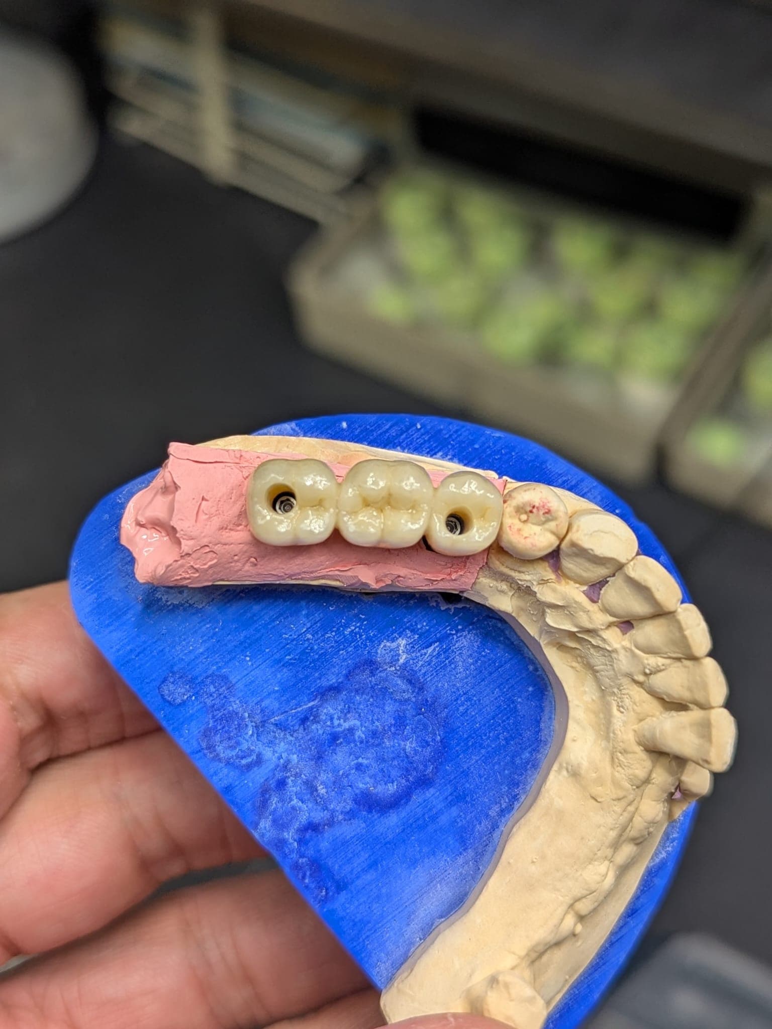 Couronne implantaire