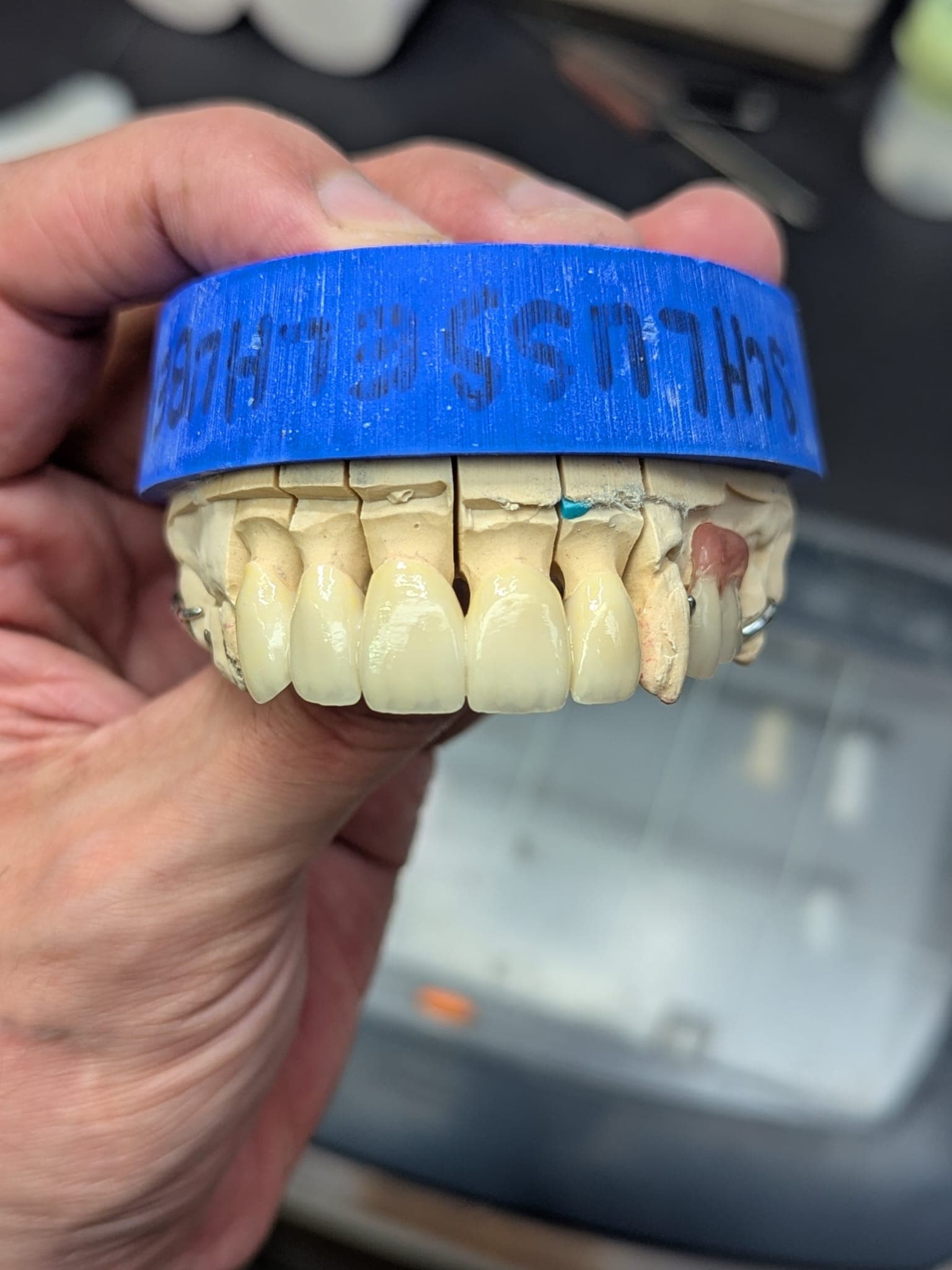 Restauration en céramique