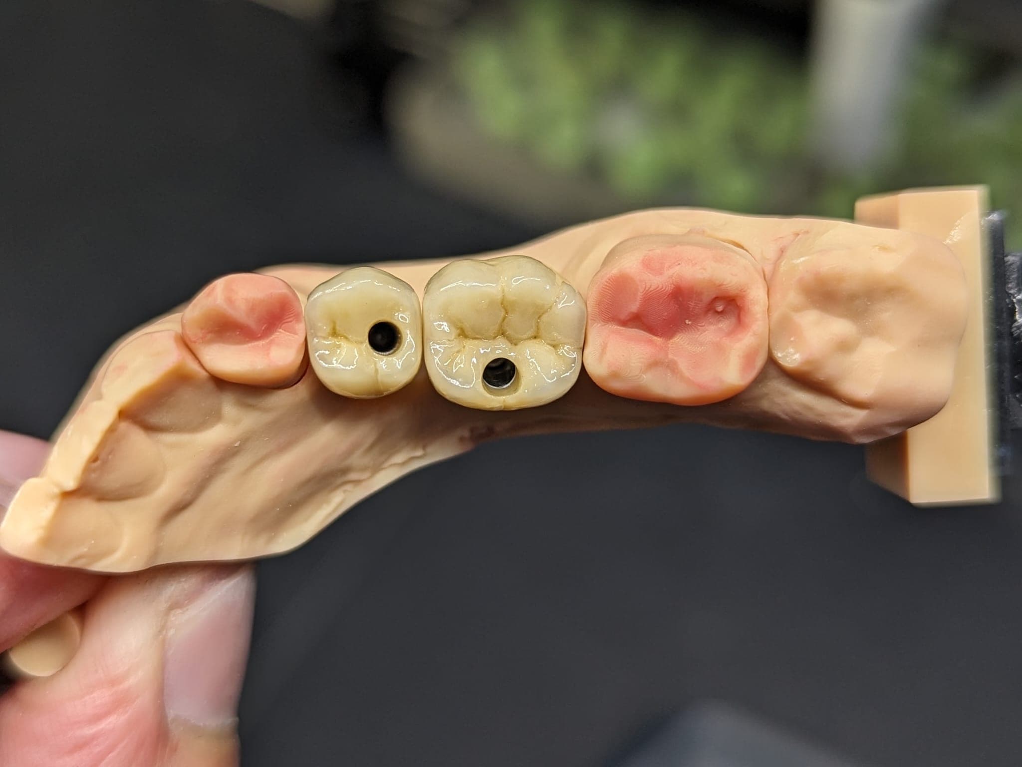 Travail implanto-porté