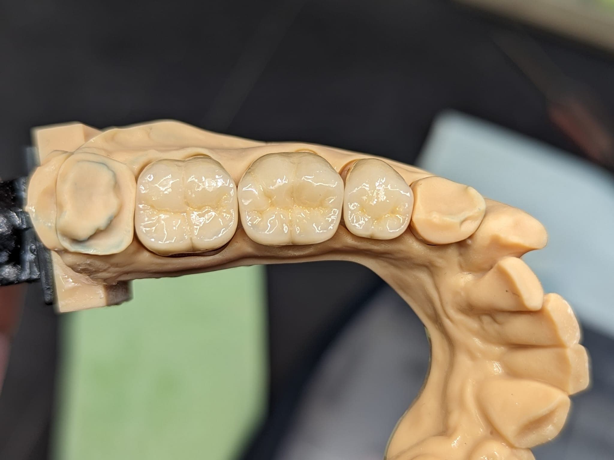 Prothèse en zircone